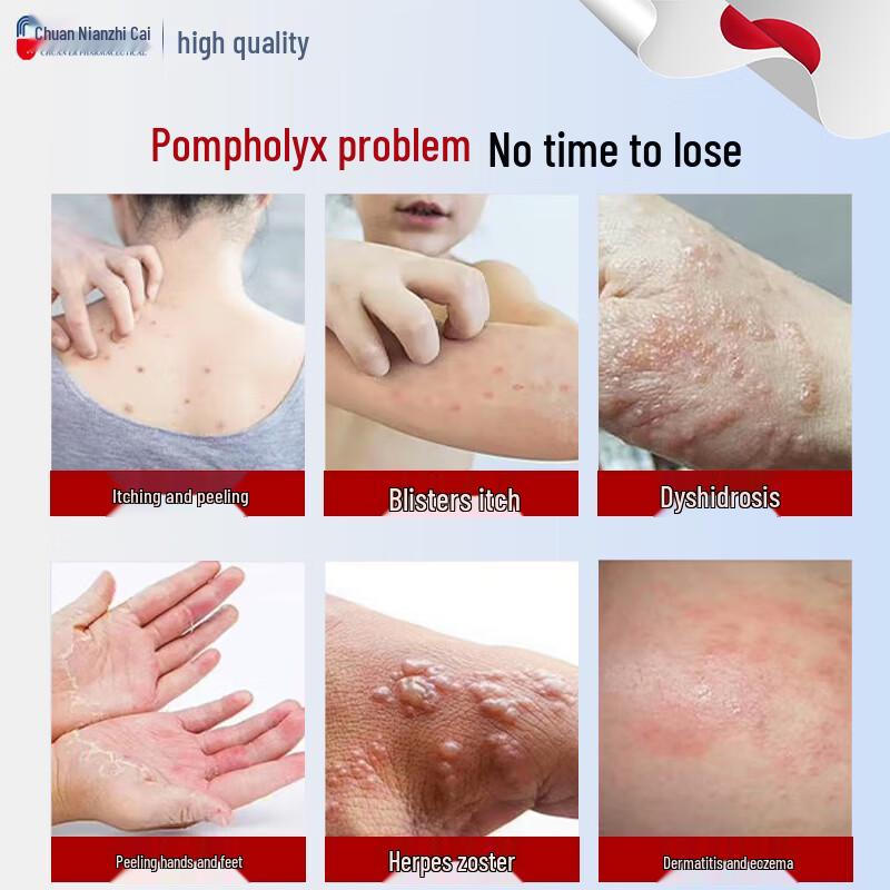 Chuan Nian Pompholyx & Eczema Relief Ointment