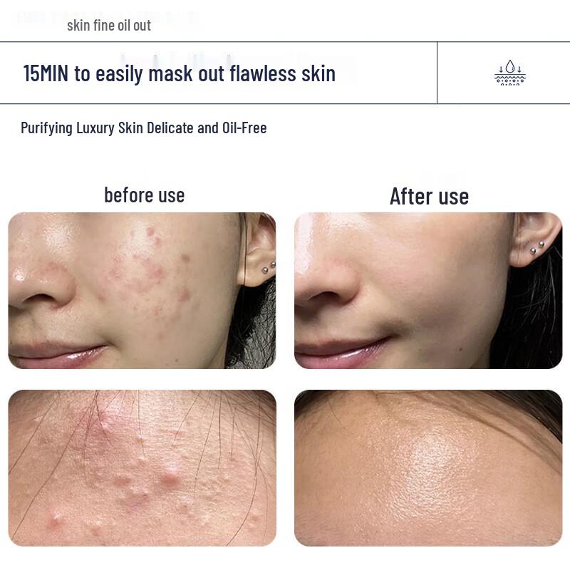 Naseki Salicylsäure Maske zur Porenreinigung und gegen Akne