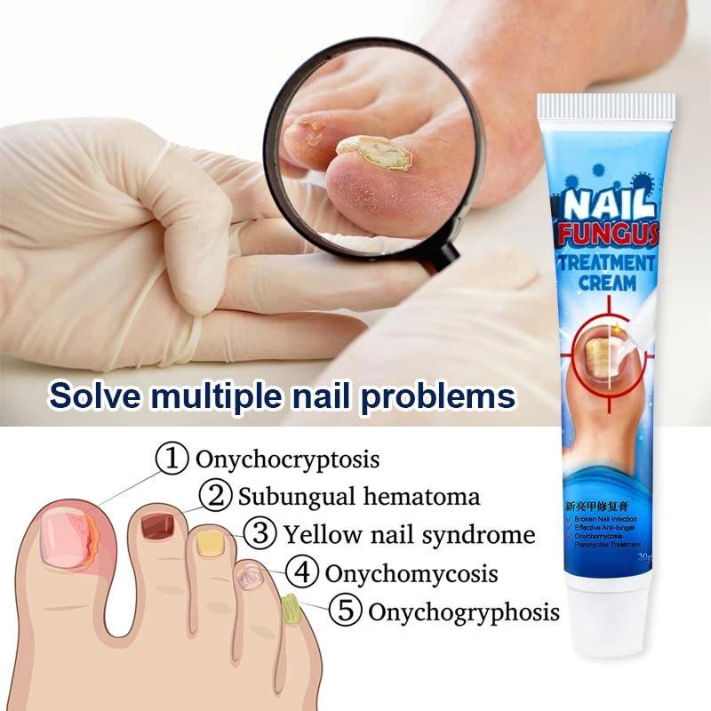 Nail Treatment Cream Antibacterial Repair Ointment Whitening Toe Anti Infection Nail Repair Cream Nail Care
