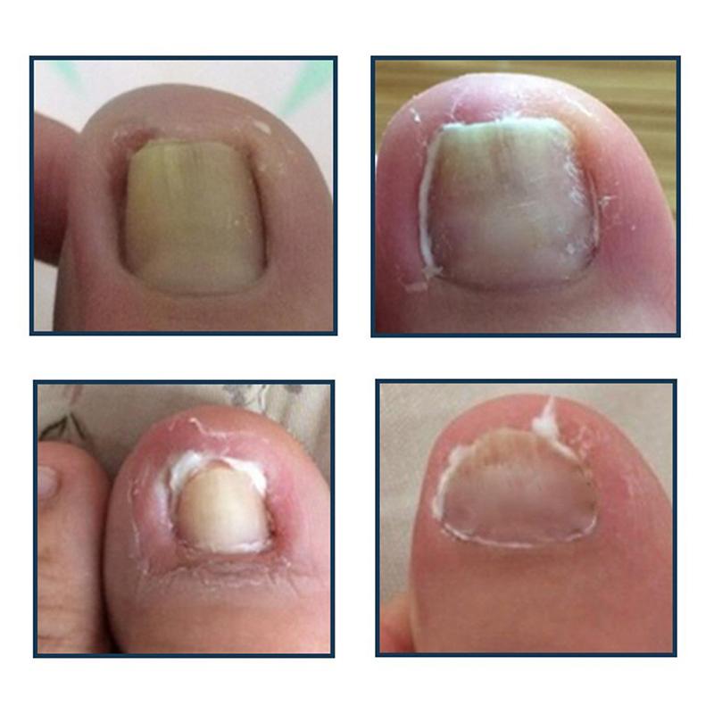 Nagelkunst Eingewachsener Zehennagel Korrekturwerkzeug Zehennagel Nagelorthese Paronychie Clip