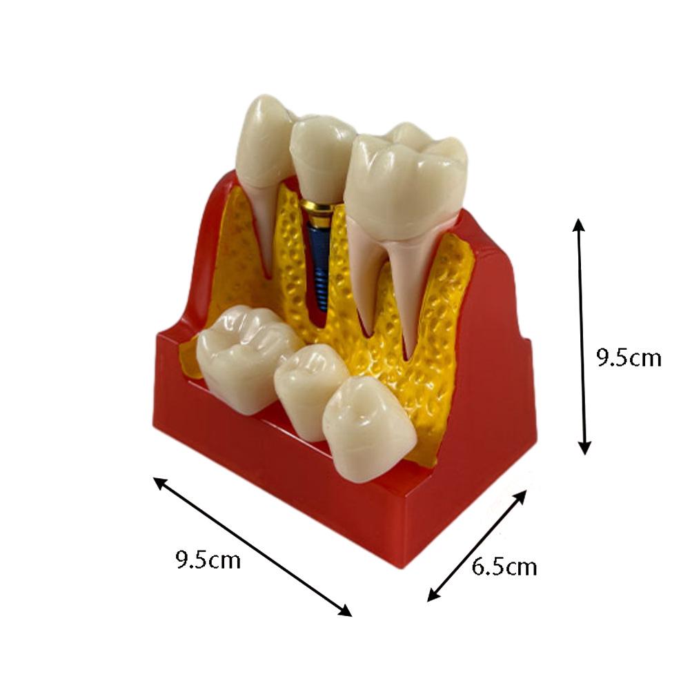 Dental Implant Teaching Model & Toothbrush Preparation Resin Mold