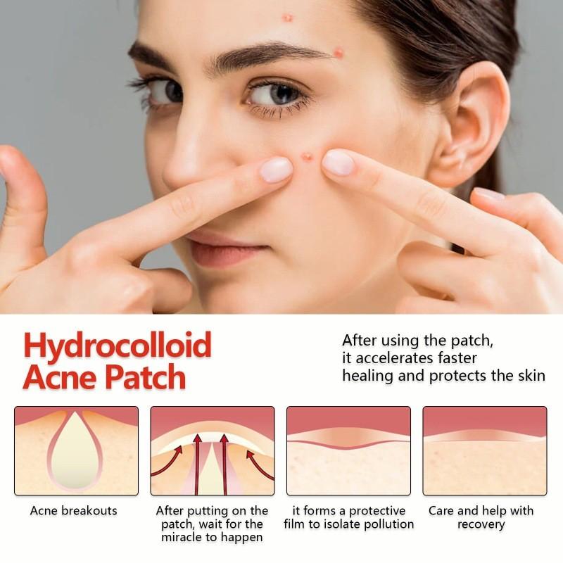 Eelhoe Colorful Acne Patches Gentle Non-irritating Hydrocolloid Treatment For Blemishes And Pimples 144pcs