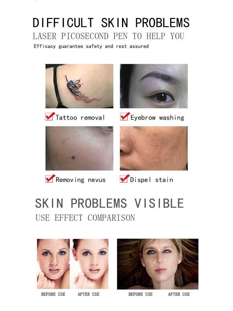 Cross-Border Red & Blue Picosecond Laser Pen for Tattoo, Mole, Freckle, and Eyebrow Removal.