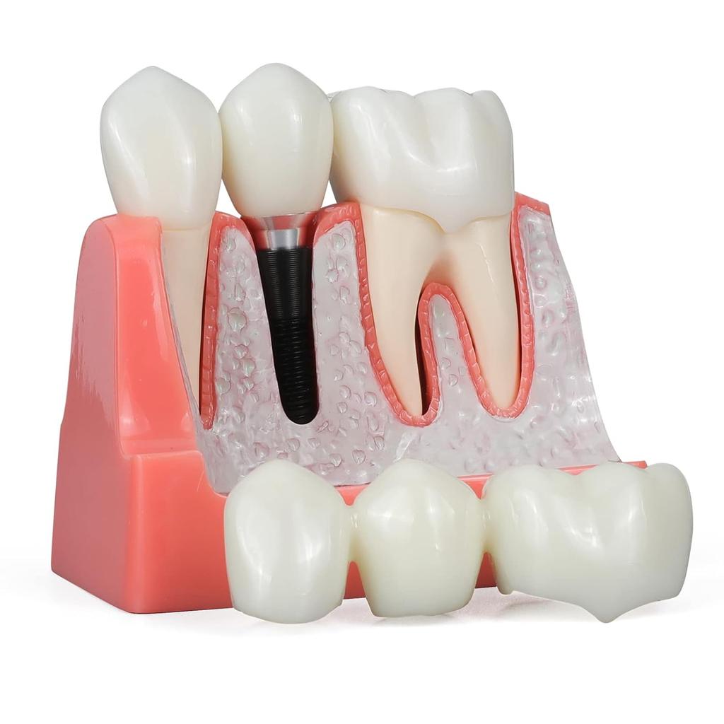 ANNWAN Dental Implant Model 4 Times Removable Analysis Crown Bridge Demonstration Teeth Model for Class Education and Studying Teeth Model