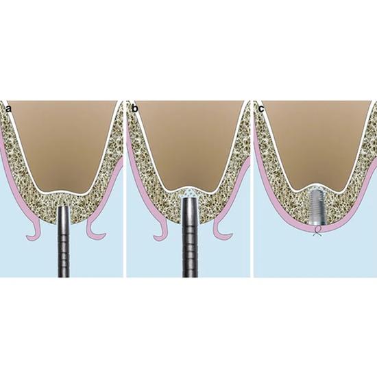 GDC Osteotomes Concave - Angulated (Ostmsh50a)