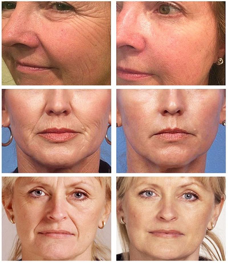 Crème blanchissante efficace contre les taches de rousseur, élimine les taches d'acné mélasma, pigment mélanine, taches foncées, hydratant, soins pour la peau