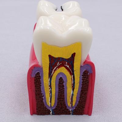 Newest 6Times Caries Comparsion Model Disease Teeth For Dental Demonstration Student Studying Dentistry Anatomy Teaching Researc
