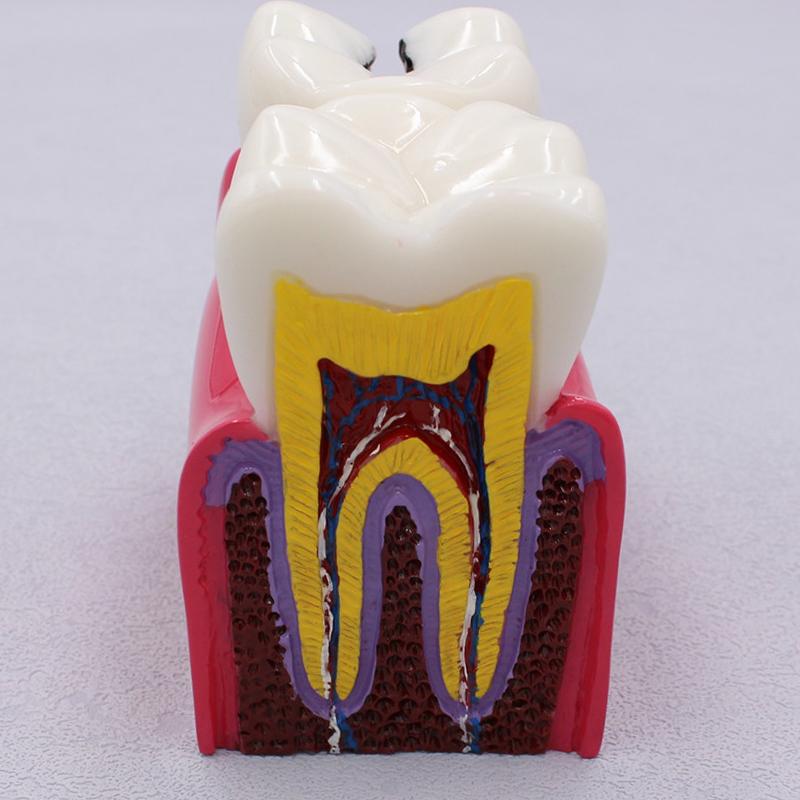 Прочный и безопасный новейший 6-кратный сравнительный модель кариеса зубов болезни для стоматологической демонстрации студенческого обучения анатомии зубов преподавания исследования