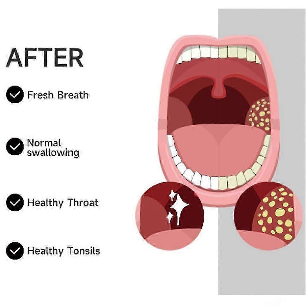 Mandelstein-Vakuumentferner, Mandelstein-Entfernungsset, Wasserdentalsauger-Werkzeug, Elektrischer Entferner Orale Cl