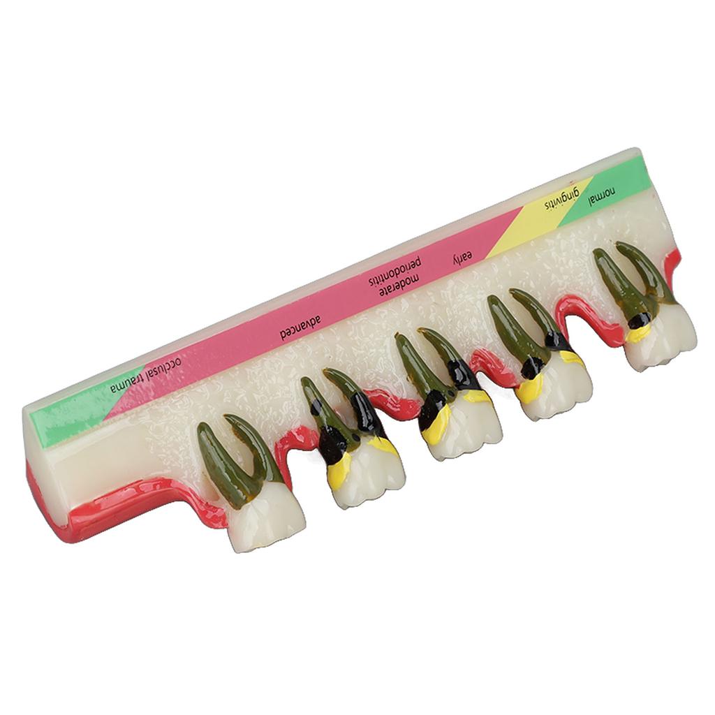 Dental Teeth Model Ceramic Clear Structure Oral Care Educational Periodontal Disease Model