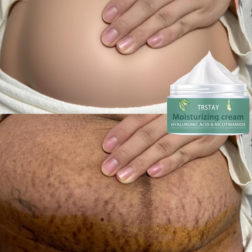 Těhotná žena strie Repair Cream Poporodní opravy a vyblednutí strií