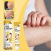 Vitiligo Treatments Cream Portable Anti-itch Body Care Cream for Skin Care