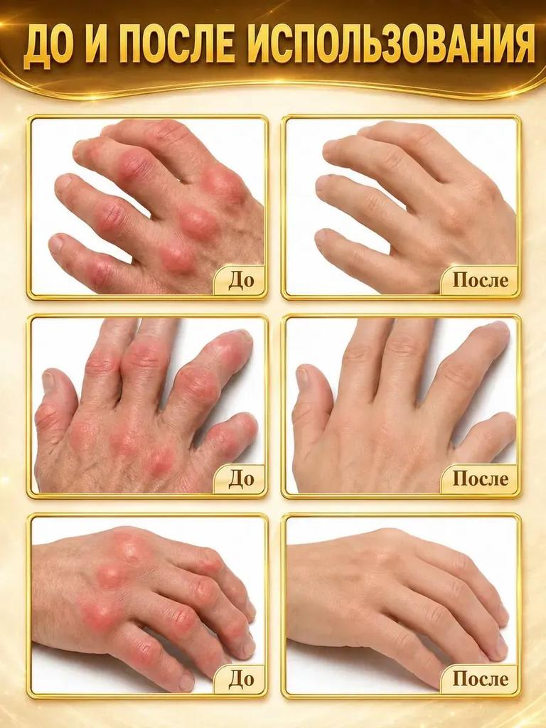 ointment for gout on the leg and for hands and arthritis