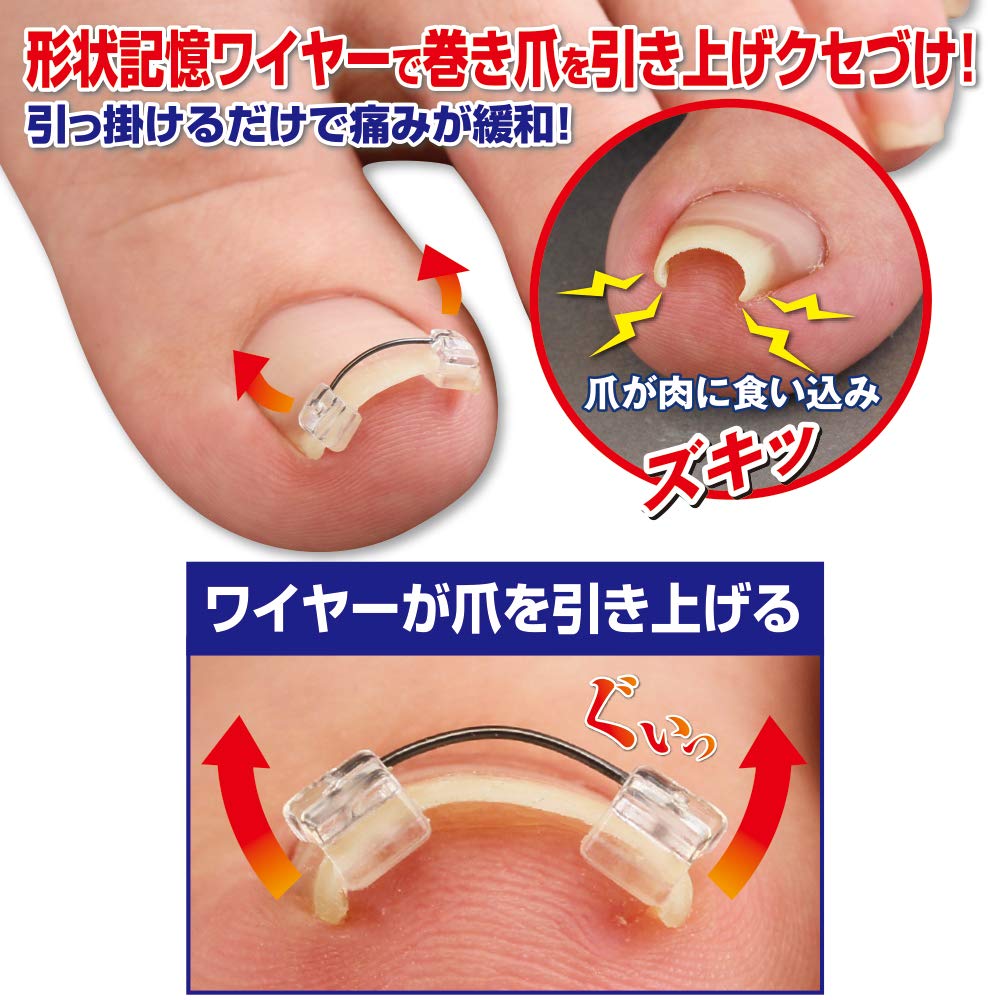 Ingrown Nail Wire Pulls Up the Shape Memory Alloy Hooks the Nail [Cyplus] Guard, Nail, Wire,