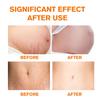 Stretch Mark Repairing-Long Lasting Skin Tenderness-Inhibit The Growth Of Striae Gravidarum-Safe To Use For Pregnant Women, 50g
