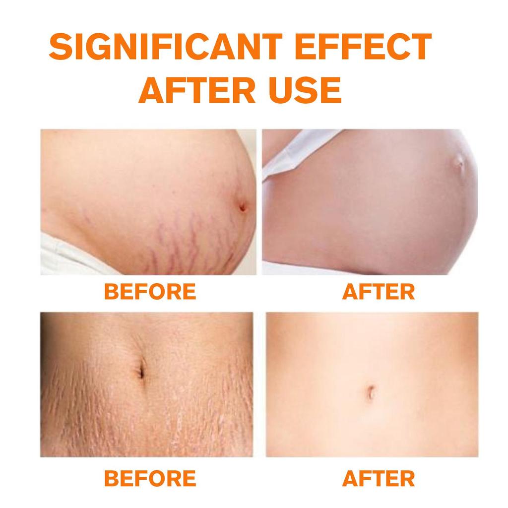 Stretch Mark Repairing-Long Lasting Skin Tenderness-Inhibit The Growth Of Striae Gravidarum-Safe To Use For Pregnant Women, 50g