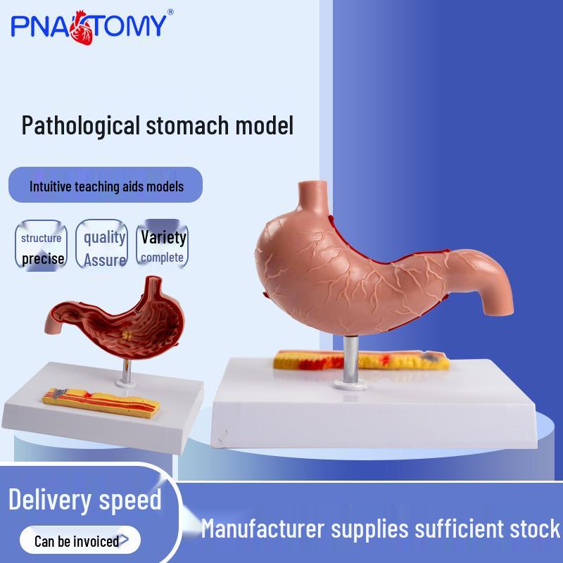 Stomach Perforation and Pathology Model - Gastroenterology Digestive System Anatomy 18 x 14 x 14 cm
