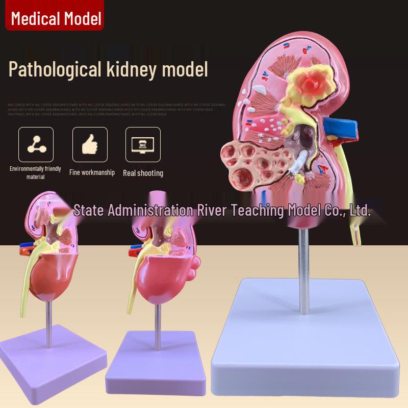 Pathological Human Kidney Anatomy Model 21 x 16 x 10 cm