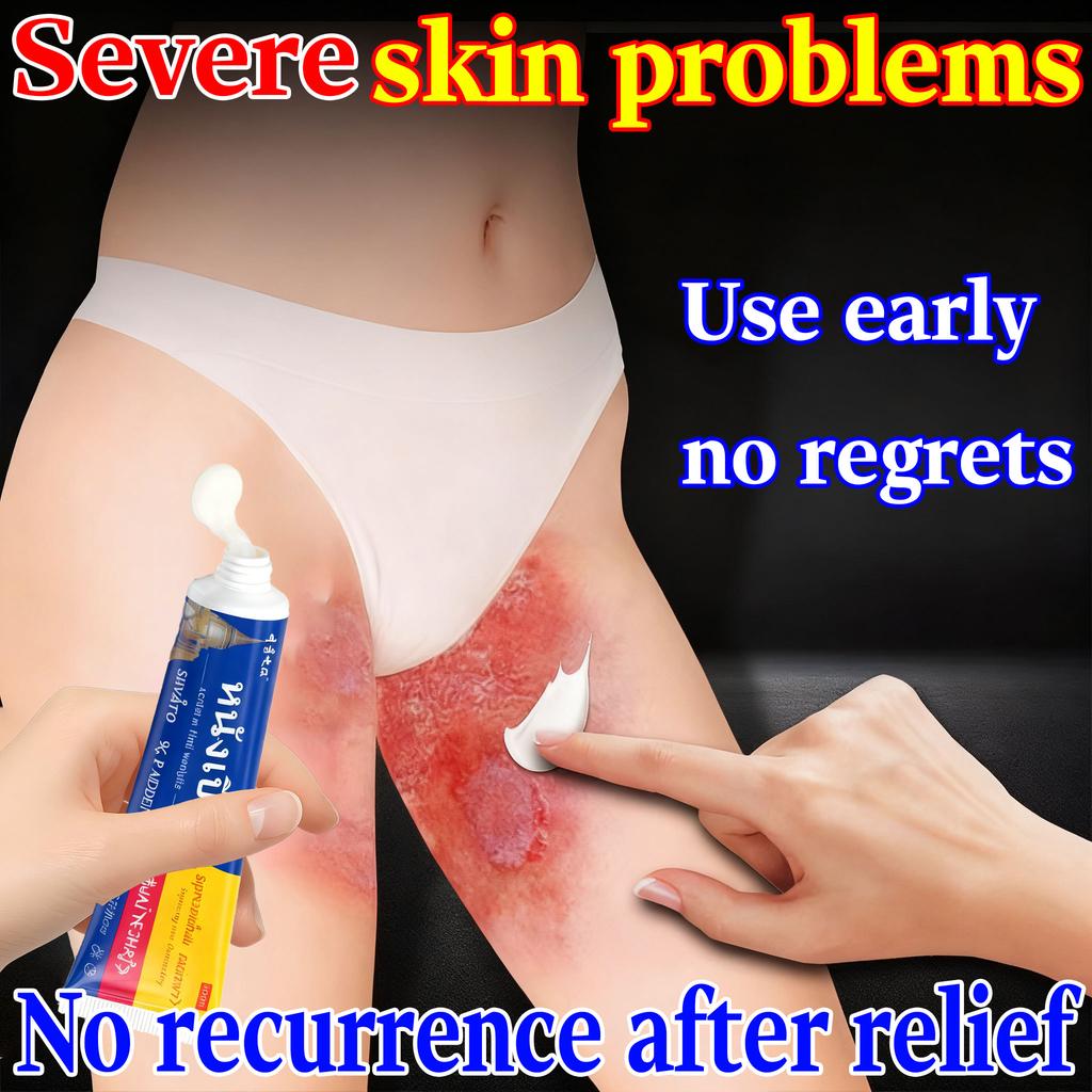 Creme para Dermatite para Pele Sensível - Ervas Naturais Aliviam a Coceira Aliviam os Sintomas de Eczema