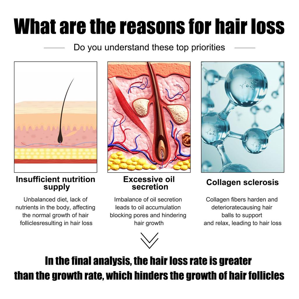 East Moon Haarwachstumsserum für Männer 30ml - Gegen Haarausfall, Stärkt das Haar, Fördert das Haarwachstum, Feuchtigkeitsspendende Haarkur