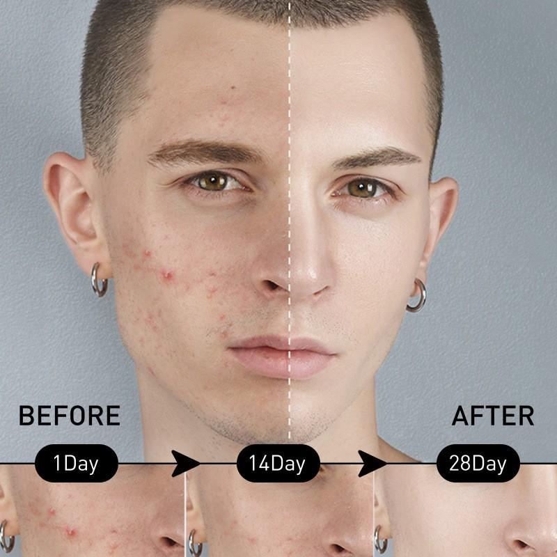 East Moon Men's Amino Acid Oil Control Facial Cleanser Deep Cleansing Acne Marks Pore Refining Brightening Skin