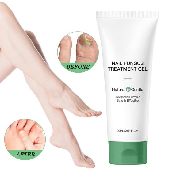 1/2Pcs 20ML Nail Fungus Treatment Gel Natural Ingredients Portable Men Women Hydrating Moisturizing Multi-Purpose Nail Repair Care Gel