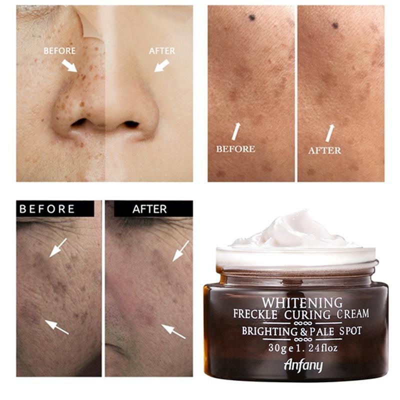 Newest Whitening Facial Cream Repair Fade Freckles Remove Dark Spots Melanin Remover Brightening Face Freckle Cream