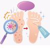New Arrival Ointment for Relieving Athlete's Foot Foot Care