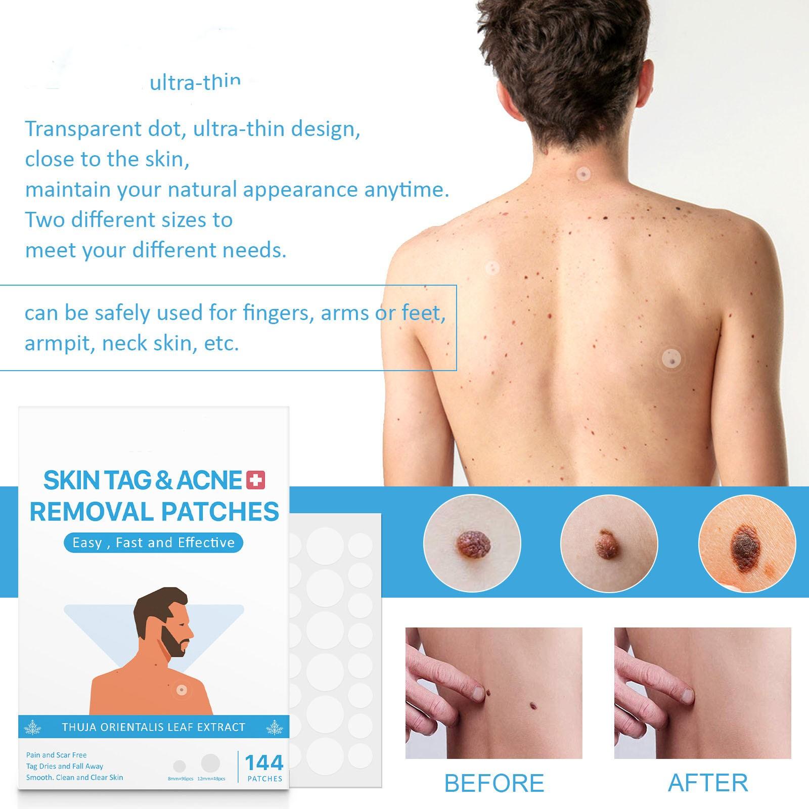 Патчи от прыщей (144 шт.) Гидроколлоидные пластыри от прыщей с салициловыми пластырями — фото 6