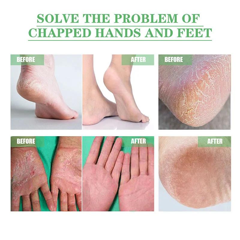 Herbal Anti Crack Foot Cream Peeling Spray Heel Cracking Repair Products Exfoliation Dead Skin Removal Softening Smooth Care