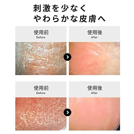 Kounbal Hornhautentferner Fuß Edelstahl Ergonomisches Design Feile, Doppelseitig, Stahl, Waschbar, Hypoallergen,