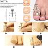 12PCS Ingrown Toenail Tool Stainless Steel Ingrown Toenail Treatment Pedicure Tools