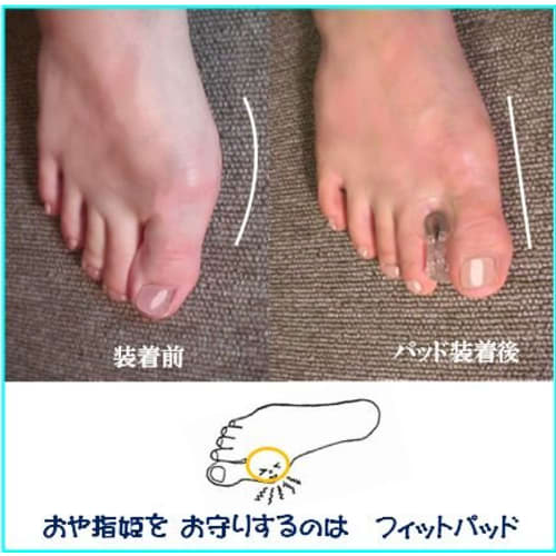 Bunion Fit Pads (2 Pieces)