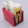 Newest 6X Caries Comparison Teeth Model For Dental Student Demonstration Teaching Dentistry Anatomy Study Research