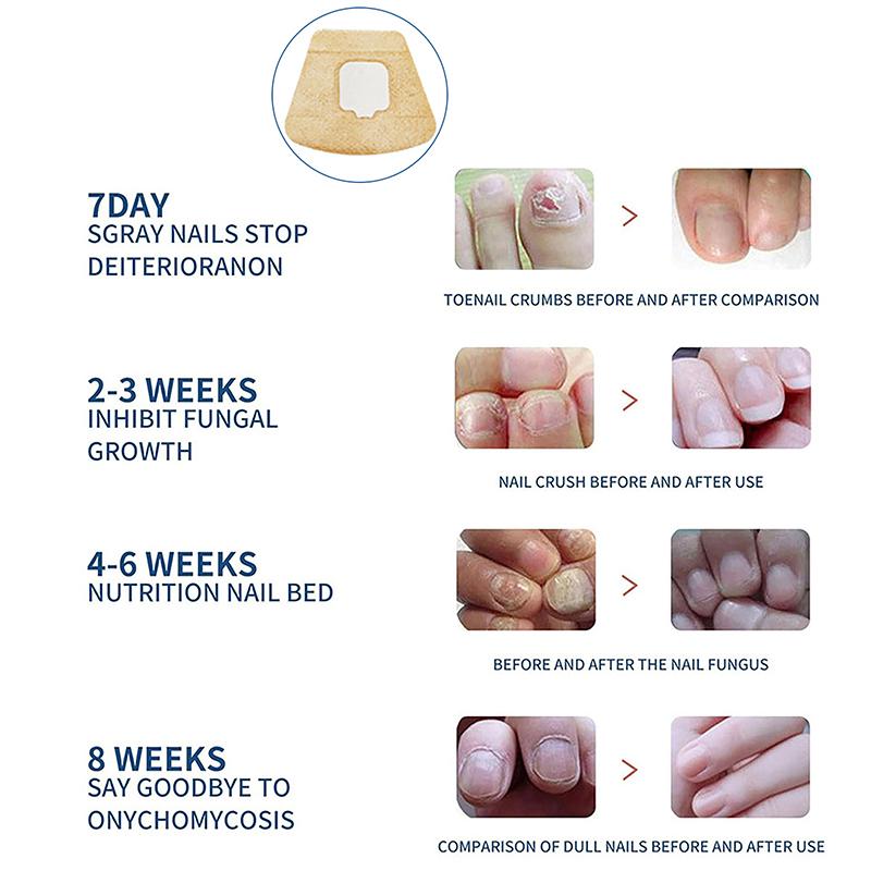 Hydrogel Nagelbehandlungspflaster Anti-Pilz Nagelkorrekturaufkleber Eingewachsene Zehennagelpflege Paronychie Anti-Infektions-Reparaturpflaster
