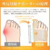 Watles Bunion Stainless Steel Fishbone Ribs for Increased Silicone Cushioning for the Easy Adjustment of Compatible with Easy to Instruction Manual