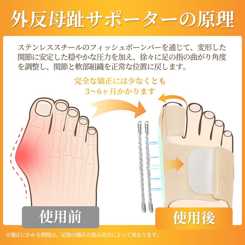 Watles Bunion Stainless Steel Fishbone Ribs for Increased Silicone Cushioning for the Easy Adjustment of Compatible with Easy to Instruction Manual