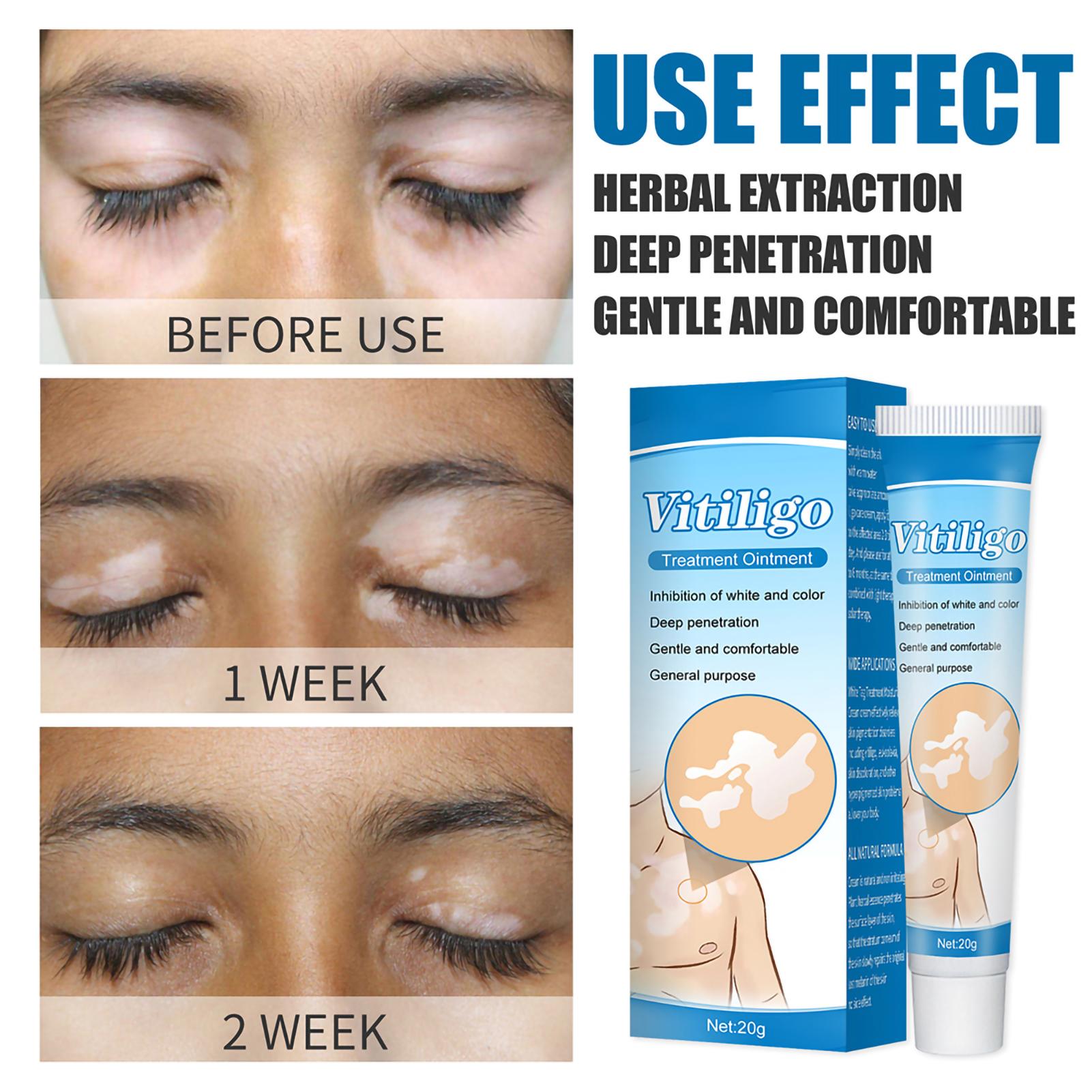 

Крем от белых пятен и пегих пятен, мазь от витилиго, травяной крем от пота, уход за кожей тела