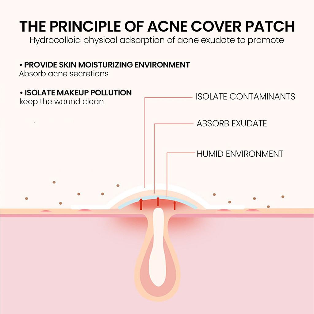 Jaysuing Love Heart Acne Patches Gentle Non Irritating Spot Treatment For Pimples