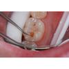 GDC Endo Spoon Excavator - 6 Exc31w