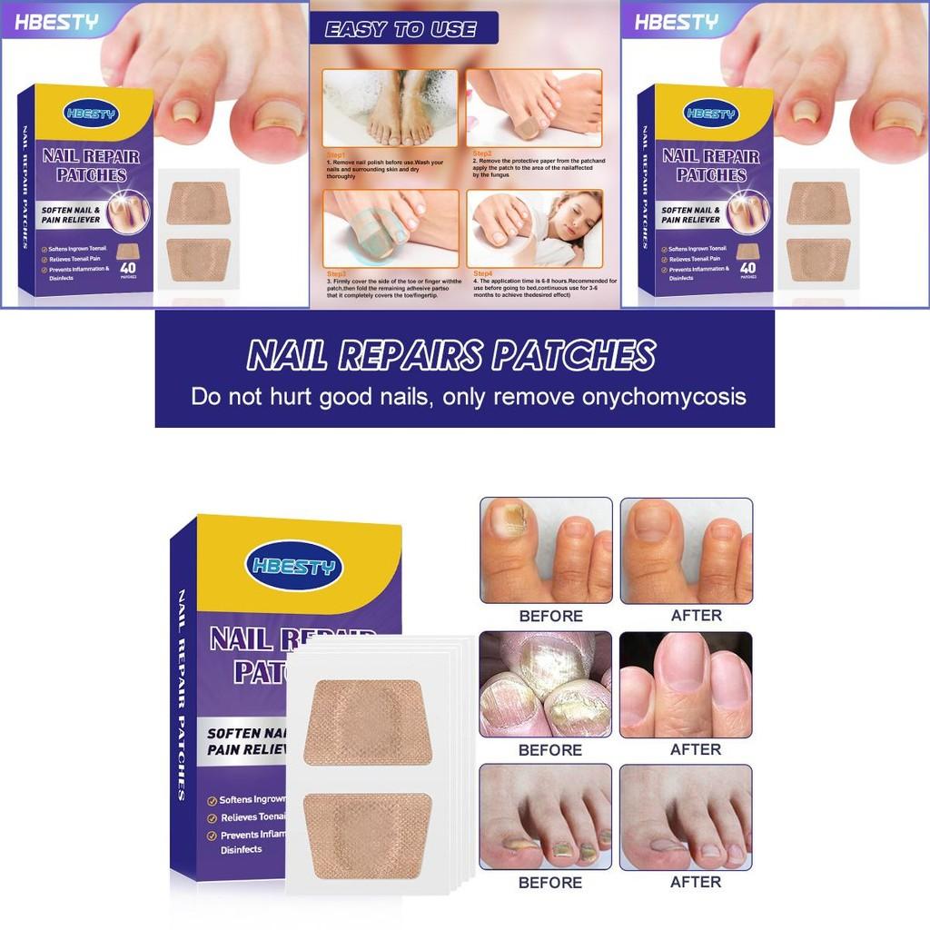 Hbesty Toenail Repair Patches For Damaged Soft Nails With Herbal Scented Comfort 40 Count