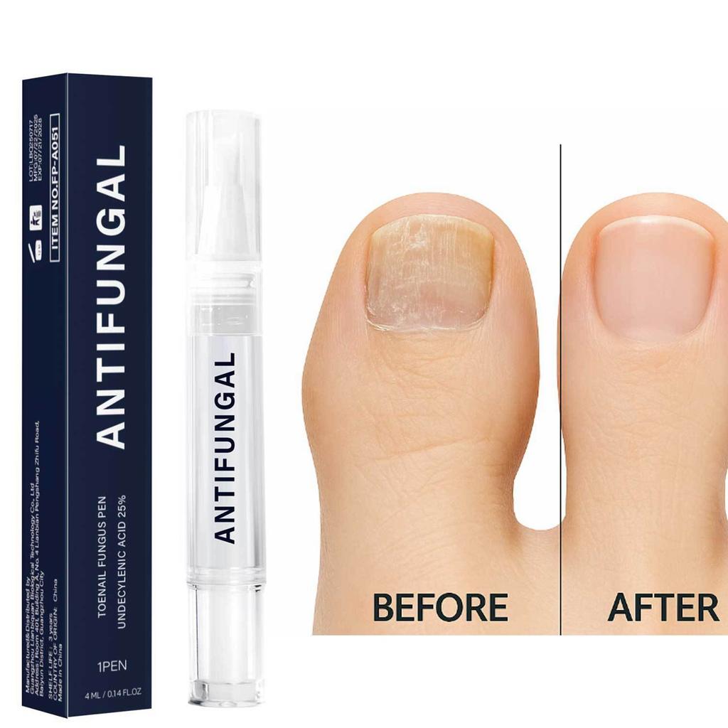 Foot Nail Pen Cracked Nail, Embedded Nail Care Solution, Soft Nail, Gray Pen 4ml