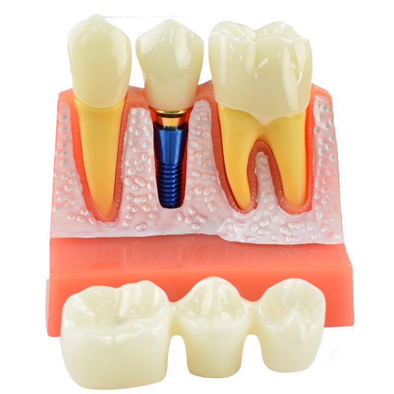 Dental Teach 4 Times Implant Analysis Crown Bridge Removable Model Dental Demonstration Teeth Model Dentisty Lab Material