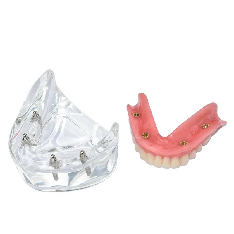 Modello Denti Dentali Trasparente 4 Impianti Overdenture Ponte Rimovibile Modello Mandibolare Inferiore M6003 Materiali per Studio Dentistico