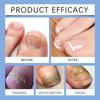 Nail Care Patches, Nail Care Correction Patches, Home Foot Patches, Comfortable And Suitable Nail Correction.