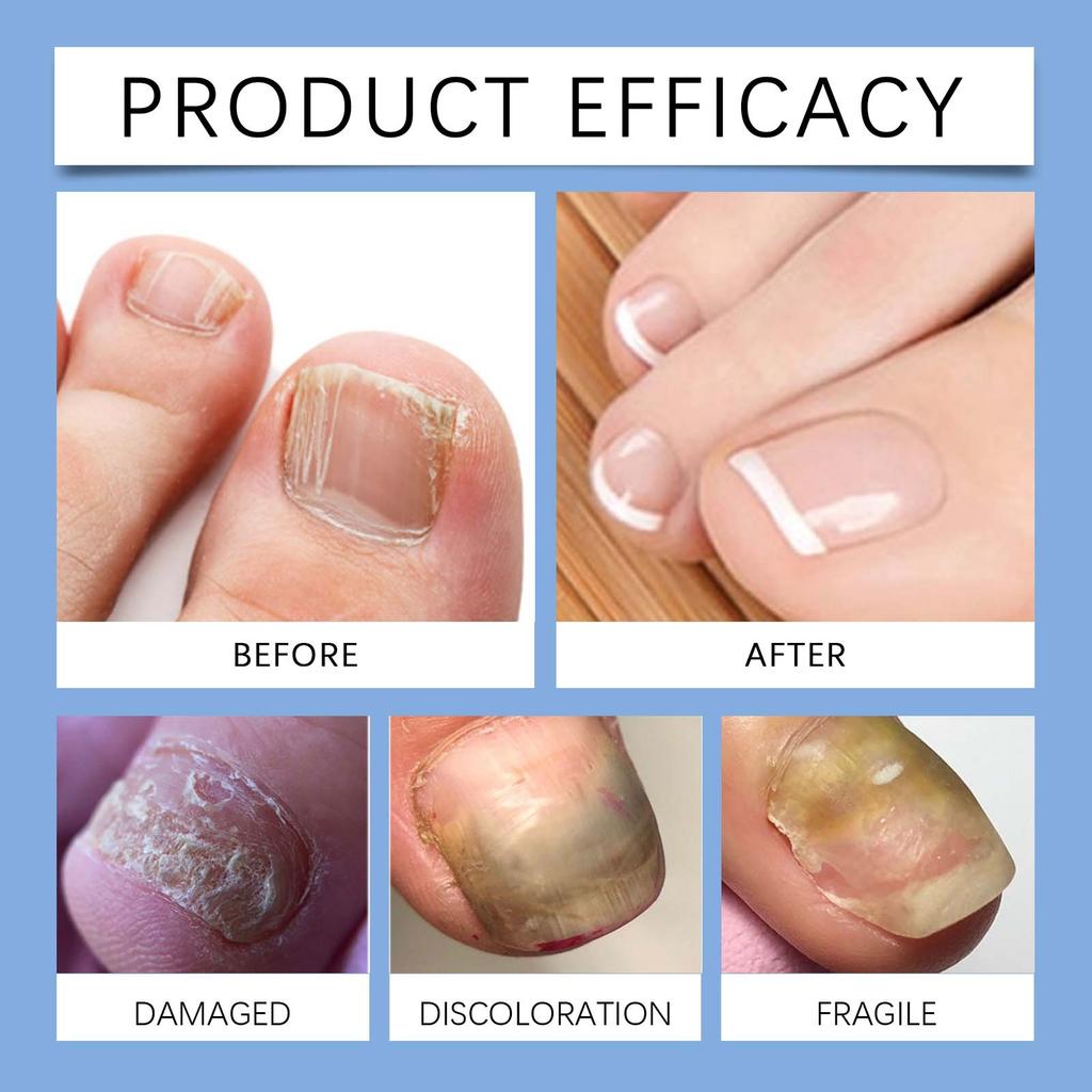 Nail Care Patches, Nail Care Correction Patches, Home Foot Patches, Comfortable And Suitable Nail Correction.