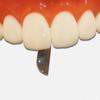 Dental Matrix Bands Anterior Matrix Strip Metal Matrices Sectional Contoured Matrix System Transparent Bow Anterior Matrices