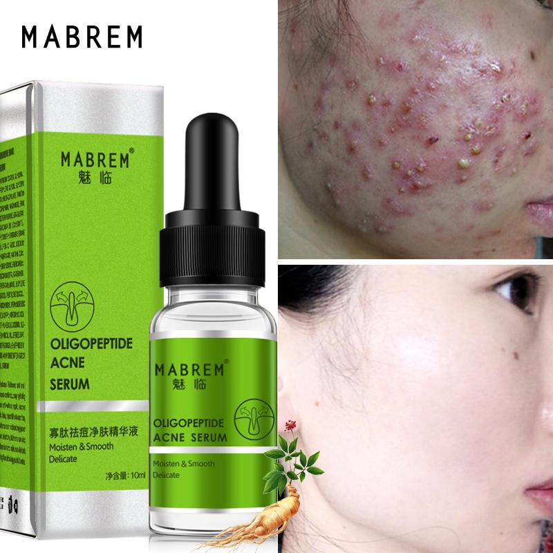 oligopeptide acne serum