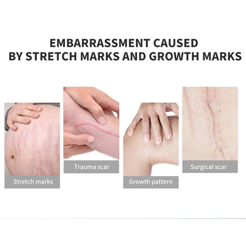 Removal Acne Scar Stretch Marks Cream Fat Scar  Treatment