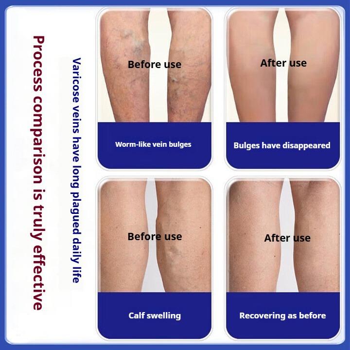 Varicose veins cold compress gel special plaster red blood swelling blue veins bulging earthworm legs dredging blocked blood vessels